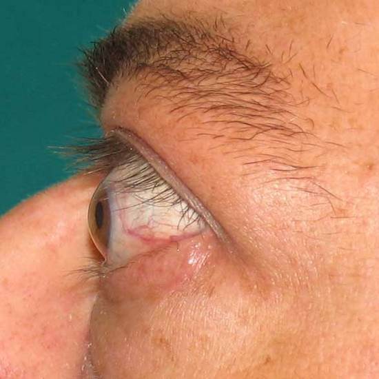 Conjunctival Pallor