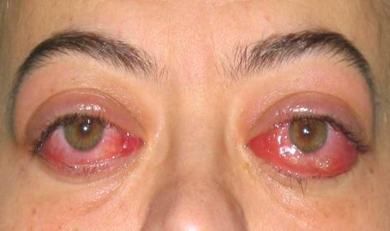 Eye Illness